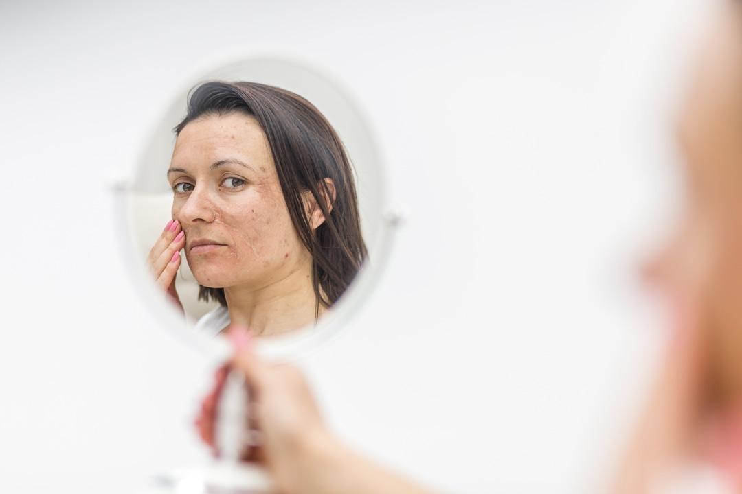 Hasarlı Cilt Tedavisinde Dermatolojik Yaklaşımlar Hasarlı Cilt Tedavisinde Dermatolojik Yaklaşımlar