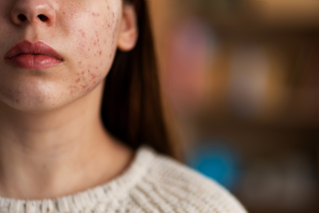 Hormonel Akne Tedavileri Hormonel Akne Tedavileri