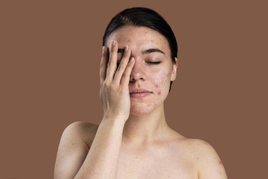 Hormonel Akne Tedavileri