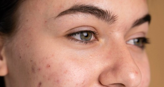 Lazerle Leke Tedavisi Hakkında Sık Sorulan Sorular