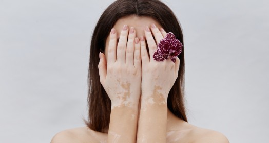 Vitiligo Nedir, Nasıl Tedavi Edilir?