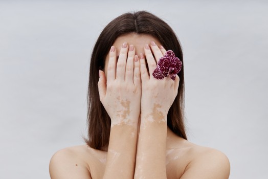 Vitiligo Nedir, Nasıl Tedavi Edilir?